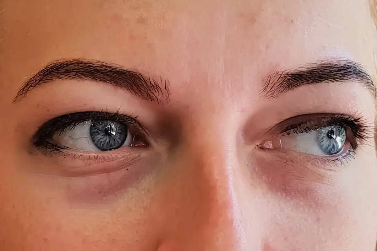 Gros plan sur des yeux bleus, avec des cernes vasculaires marqués sous les paupières inférieures, donnant un aspect fatigué.