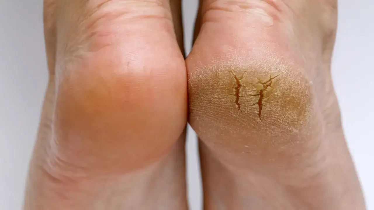 Pieds secs et craquelés, une peau abîmée qui pourrait bénéficier d'un traitement à l'acide glycolique pour retrouver douceur et souplesse.