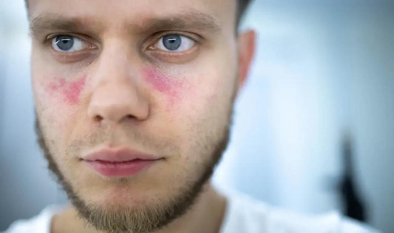 Gros plan sur un visage rouge alcool, avec des rougeurs prononcées sur les joues et sous les yeux.