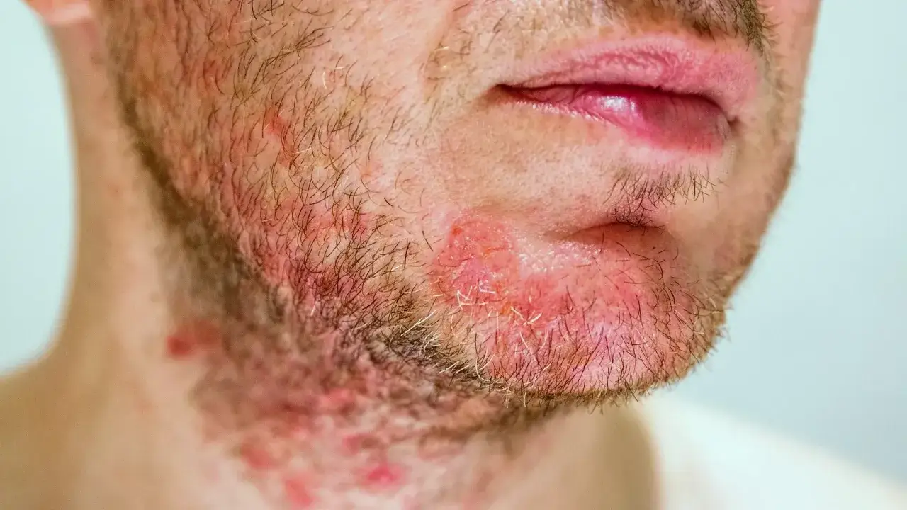 Gros plan sur une barbe avec un bouton d'ecz&eacute;ma rouge et irrit&eacute; sur le menton et le cou.