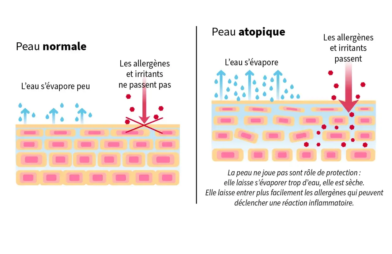 Peau normale vs atopique : la seconde souffre d'une perte insensible en eau, laissant passer allergènes et irritants.