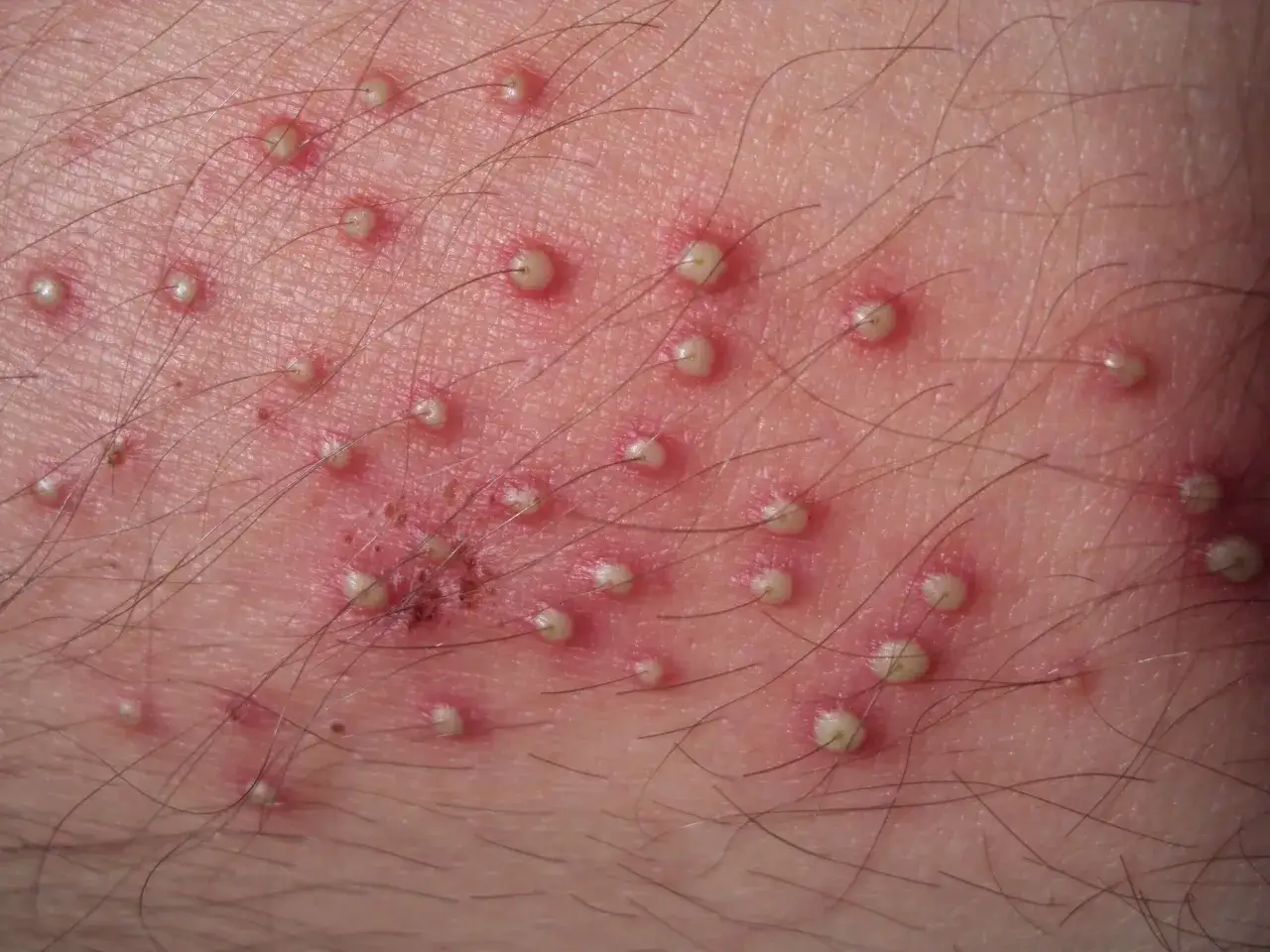 Gros plan sur une peau irrit&eacute;e par de nombreux petits boutons rouges avec un point blanc au sommet, entour&eacute;s de poils fonc&eacute;s.