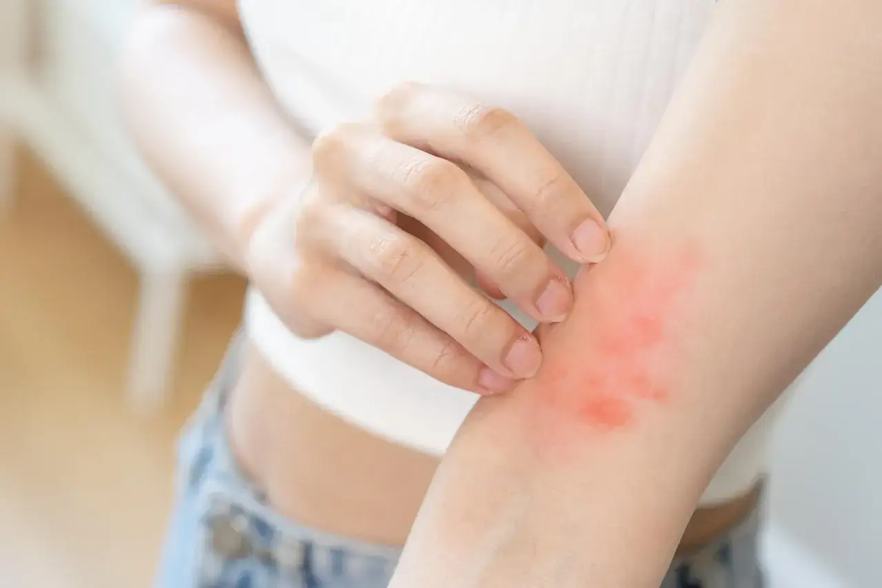 Une main gratte une éruption cutanée rouge sur le bras, signe du début d'eczéma.