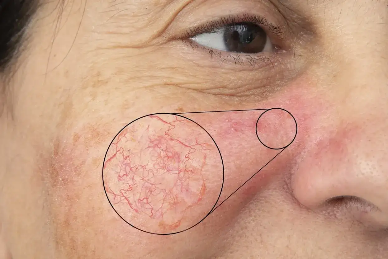 Gros plan sur un visage montrant des rougeurs et des vaisseaux sanguins dilatés, typiques de l'érythrose du visage.