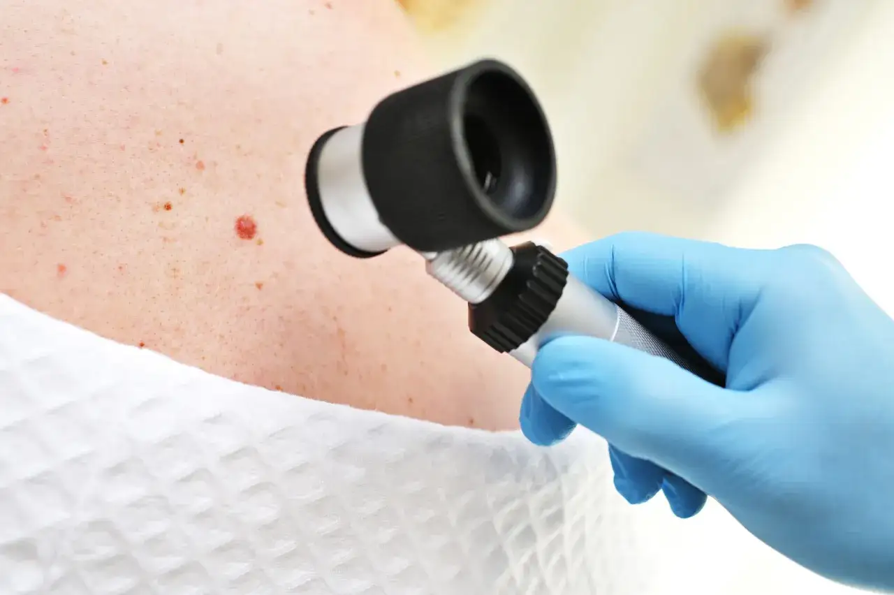 Examen d'un grain de beauté soleil avec un dermoscope. Une main gantée tient l'instrument pour examiner la peau.