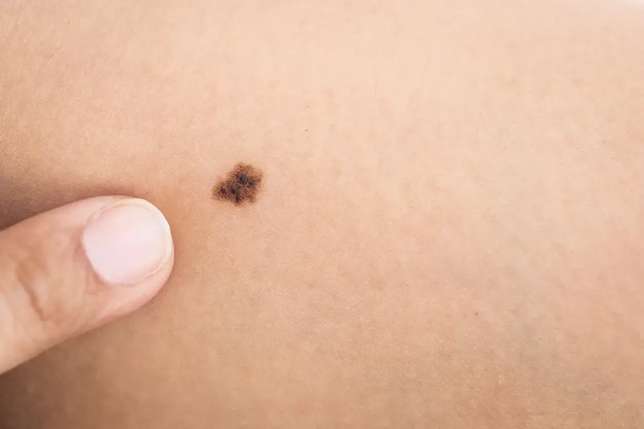 Gros bouton noir sur la peau, une tache pigment&eacute;e irr&eacute;guli&egrave;re, est examin&eacute;e par un doigt.