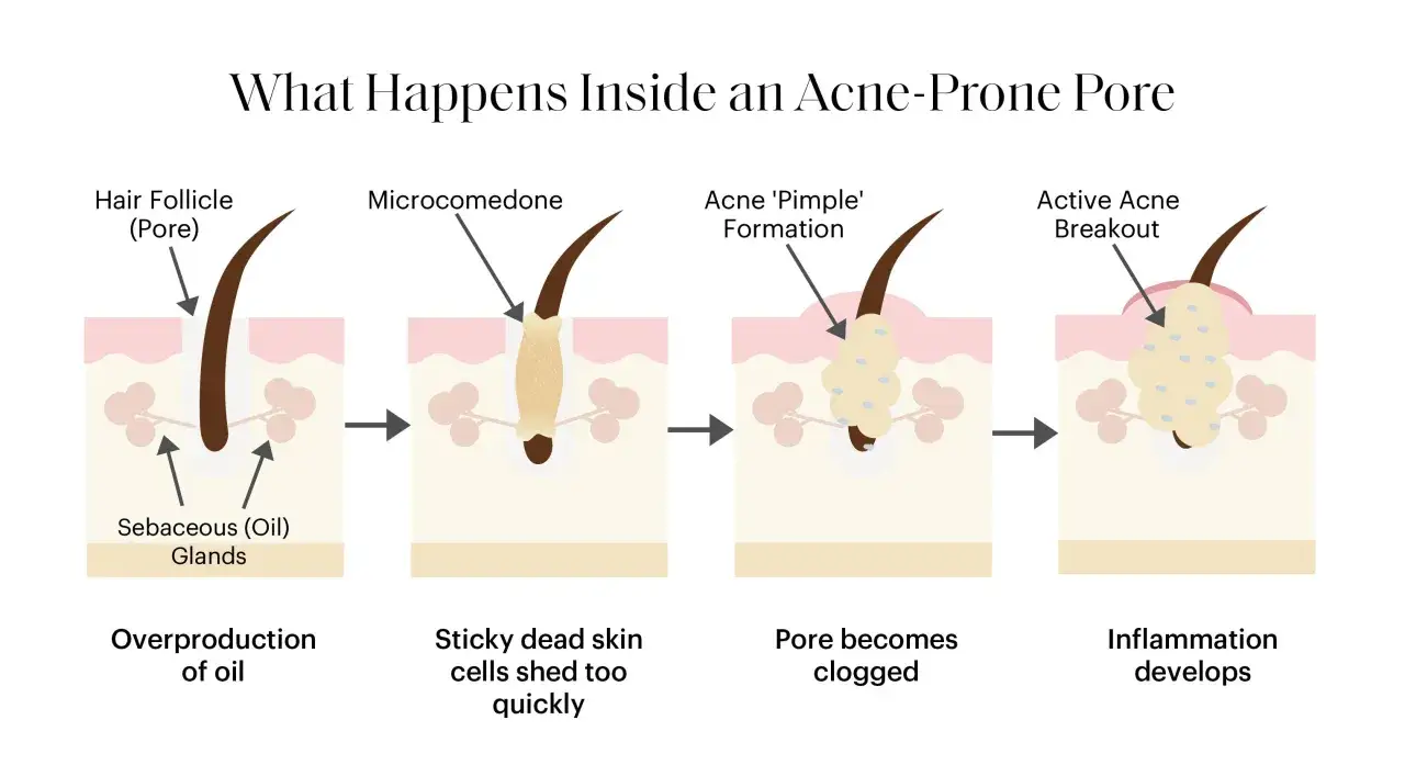 Illustration montrant la formation d'un comédon et d'un bouton, de l'excès de sébum à l'inflammation.