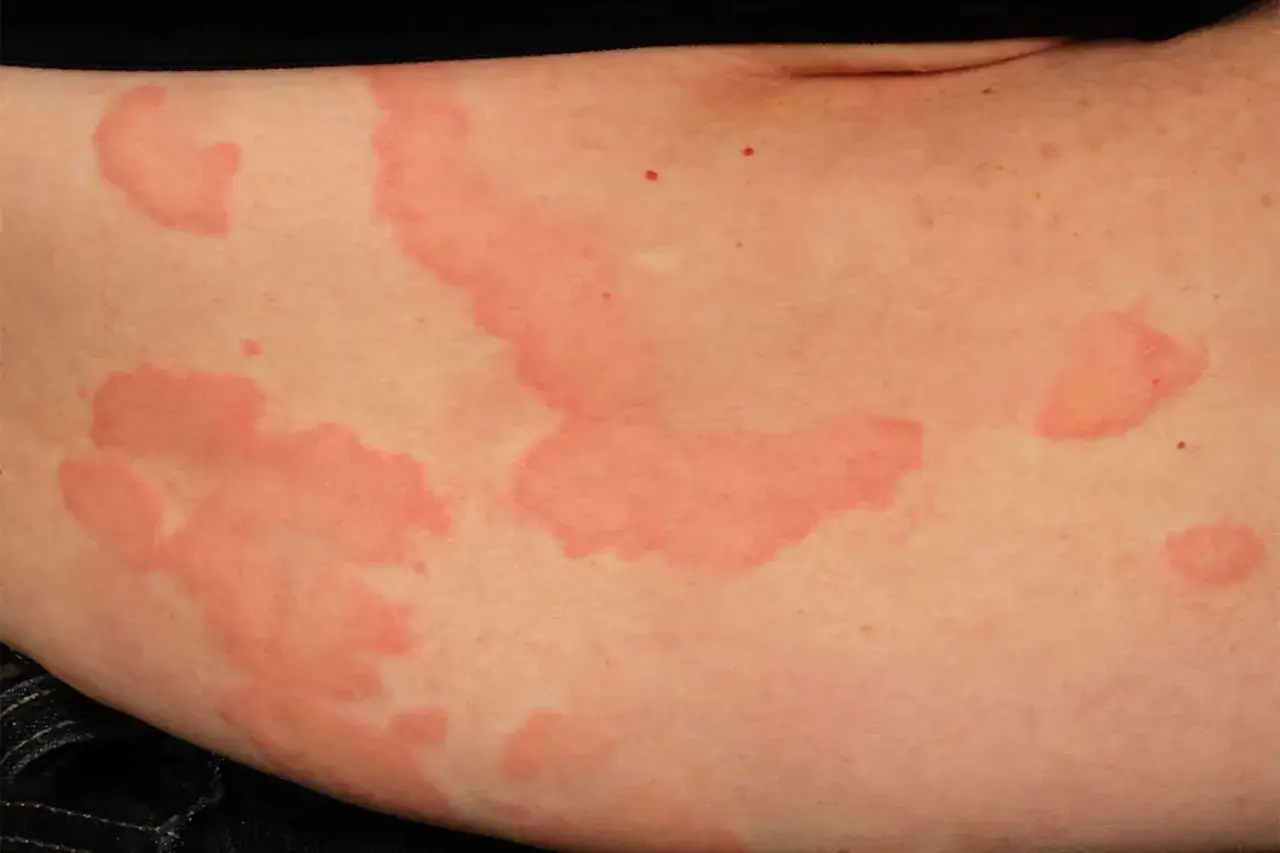 Grosses plaques rouges et surélevées sur la peau, signe d'un bouton de stress qui gratte.