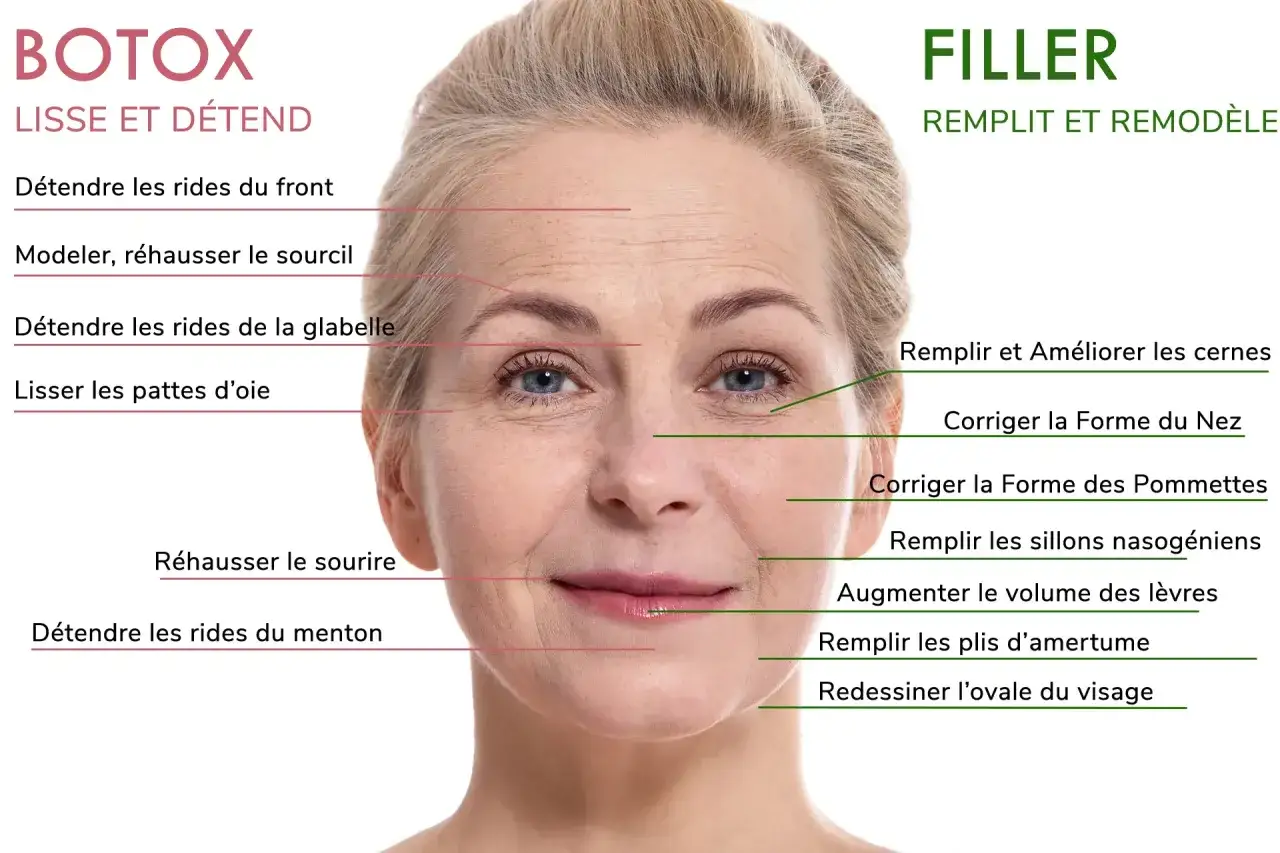 Visage d'une femme montrant les zones d'action du Botox et des fillers pour att&eacute;nuer les rides du visage signification.