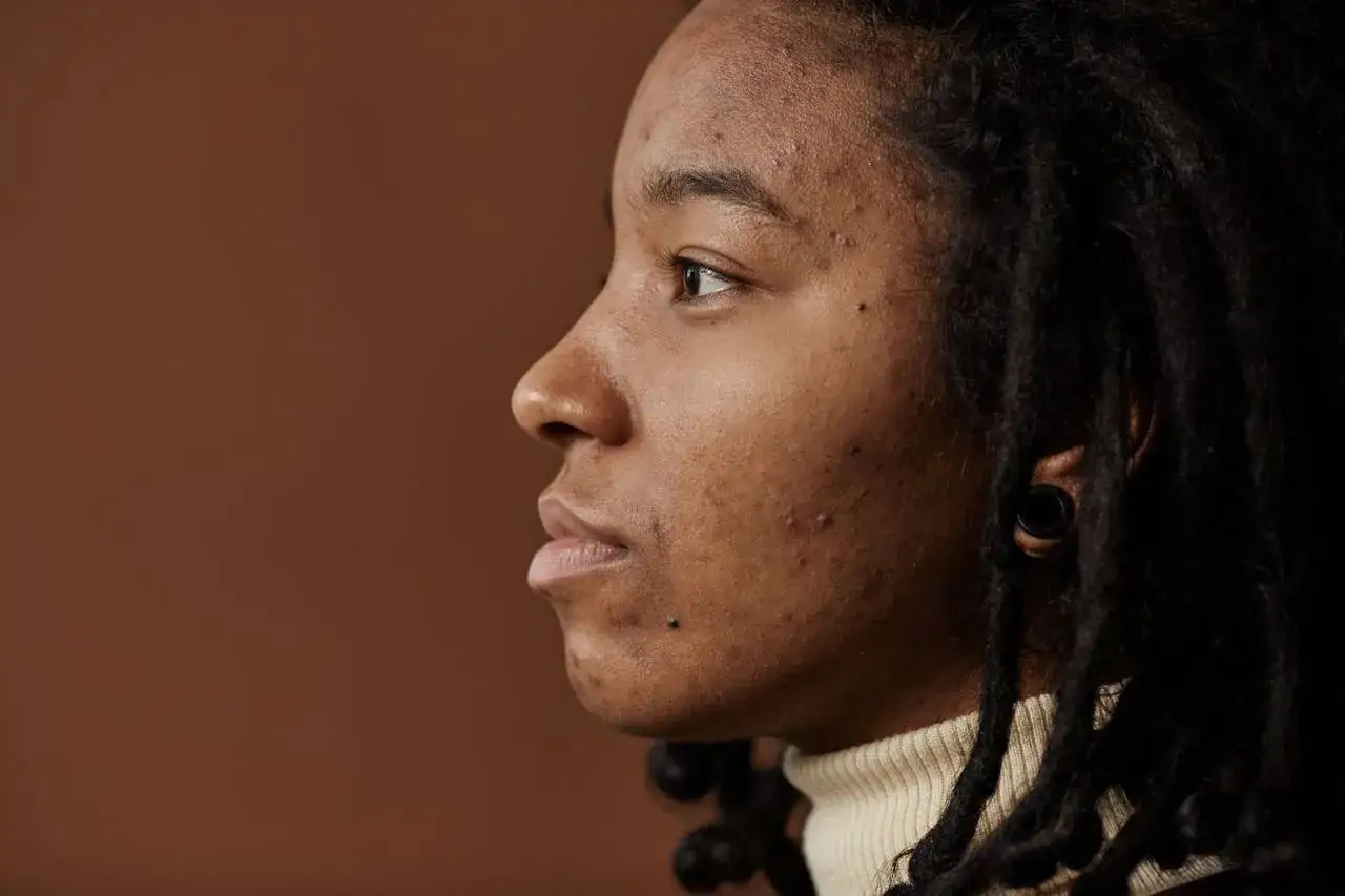 Profil d'une jeune femme aux dreadlocks, sa peau présente des marques d'acné de grossesse.