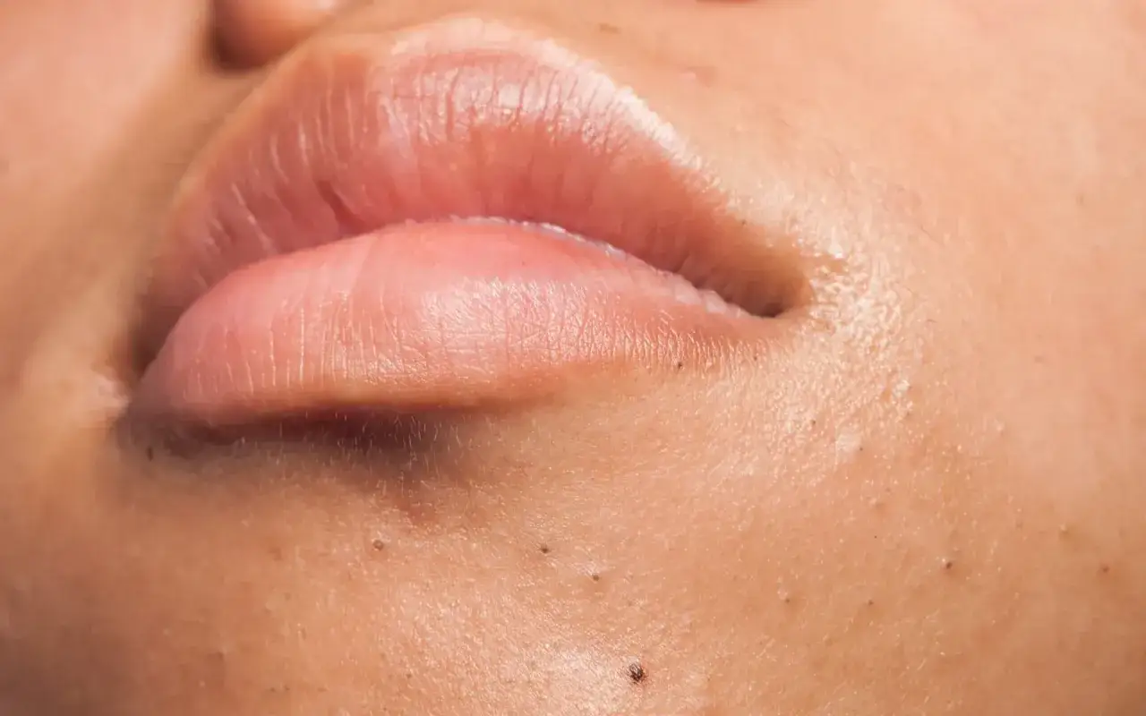 Gros plan sur des lèvres roses et une peau présentant plusieurs petits points noirs, dont un bouton avec point noir au milieu.
