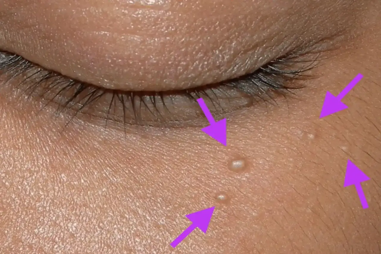 Flèches violettes pointant vers plusieurs petits points blancs sur la peau, dont un grain de milium infecté près de l'œil.