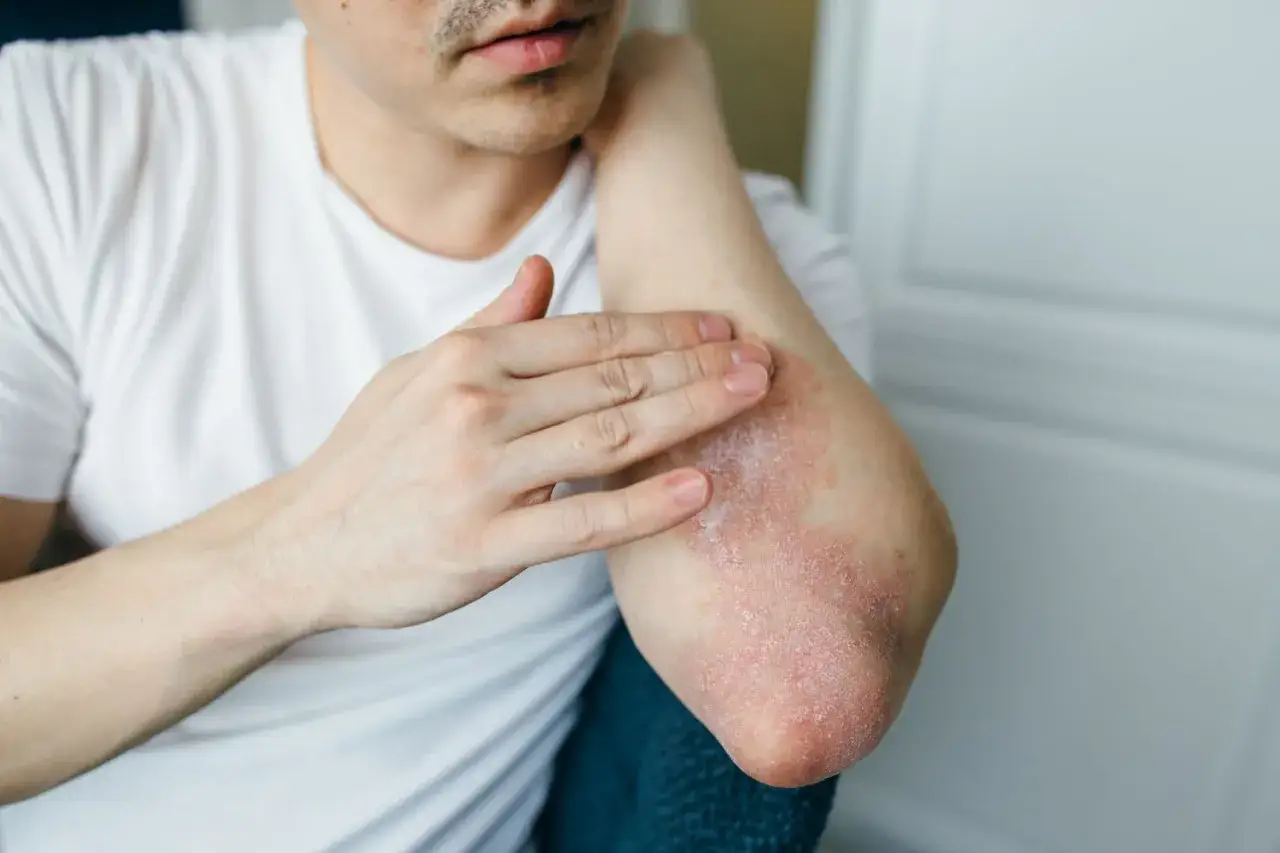 Un homme applique une cr&egrave;me sur son coude atteint d'ecz&eacute;ma. La peau est rouge et squameuse, signe d'une pouss&eacute;e d'ecz&eacute;ma &agrave; l'&eacute;paule.