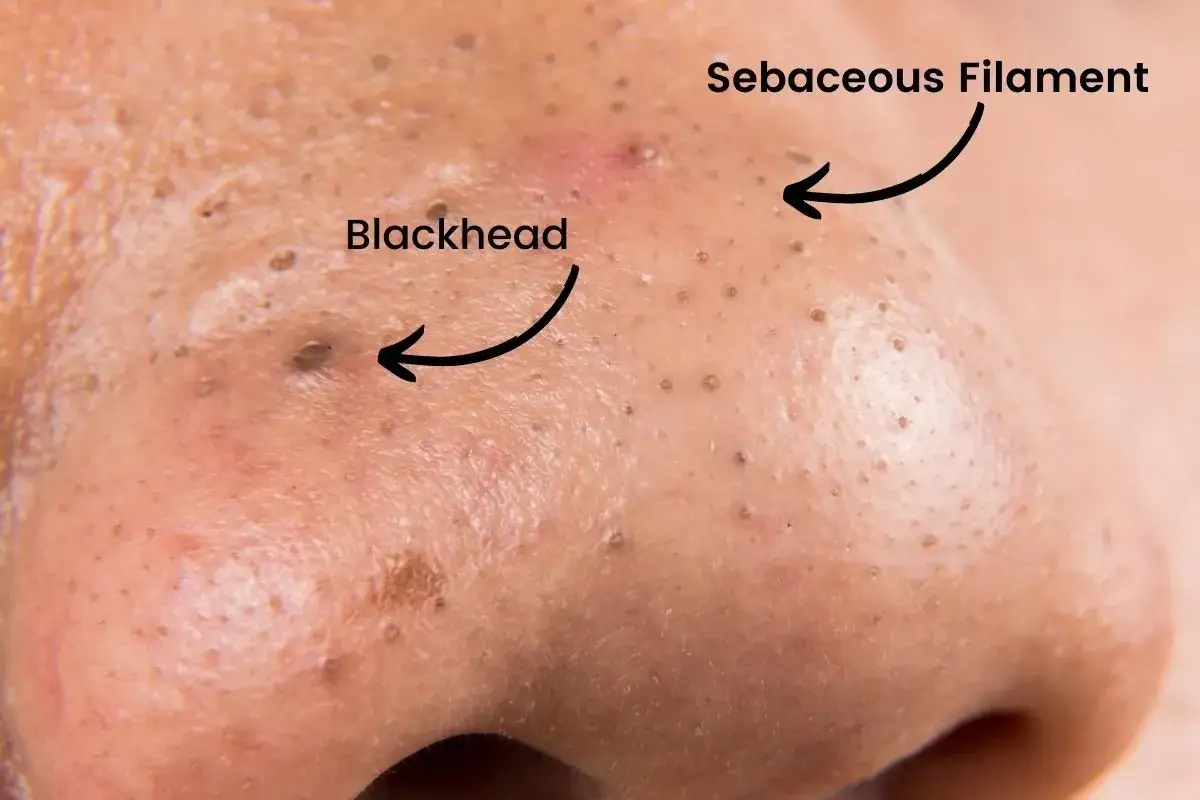 Gros plan sur le nez, montrant un point noir et un filament sébacé. Ces petites imperfections cutanées peuvent parfois être confondues.