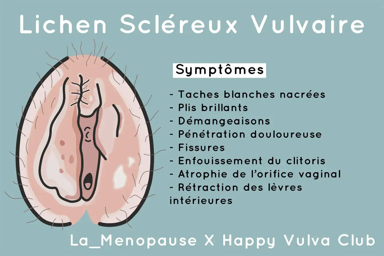 Illustration d'une vulve avec des symptômes du lichen scléreux, dont une plaque rouge. La description liste des signes comme des démangeaisons et des fissures.