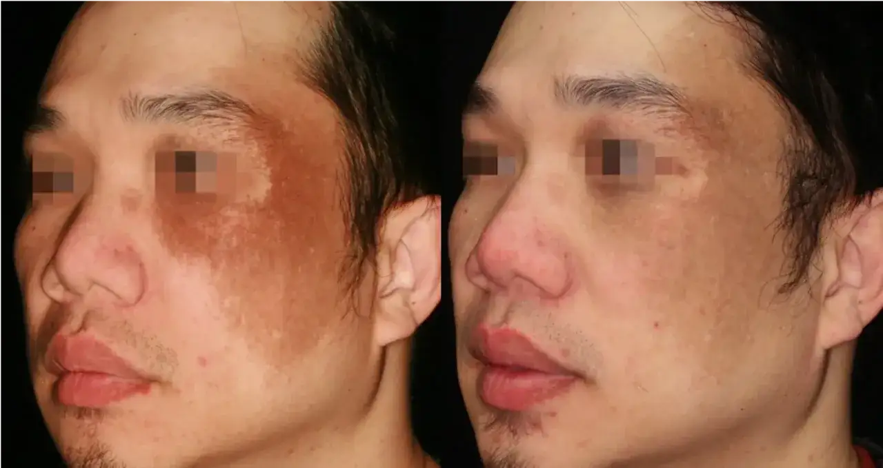 Avant/après : une peau avec des taches pigmentaires sur la joue et le nez, avant et après un traitement pour comment enlever les taches sur le visage en 3 jours.