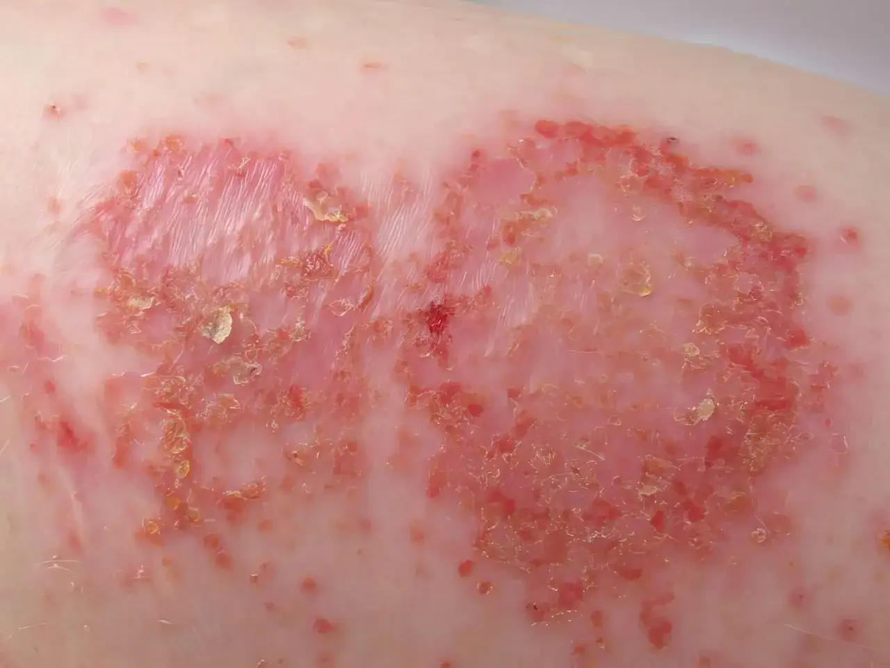 Plaque rouge et squameuse sur la peau, typique d'un ecz&eacute;ma nummulaire. La peau est irrit&eacute;e et pr&eacute;sente des zones de desquamation.