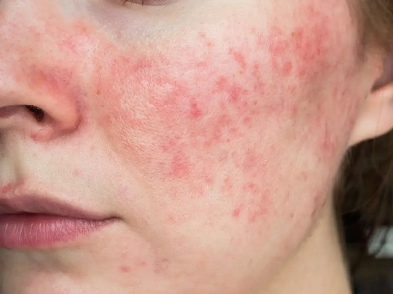 Peau rougie et irritée, avec des boutons. L'acide azélaïque peut présenter un danger pour certaines peaux sensibles.