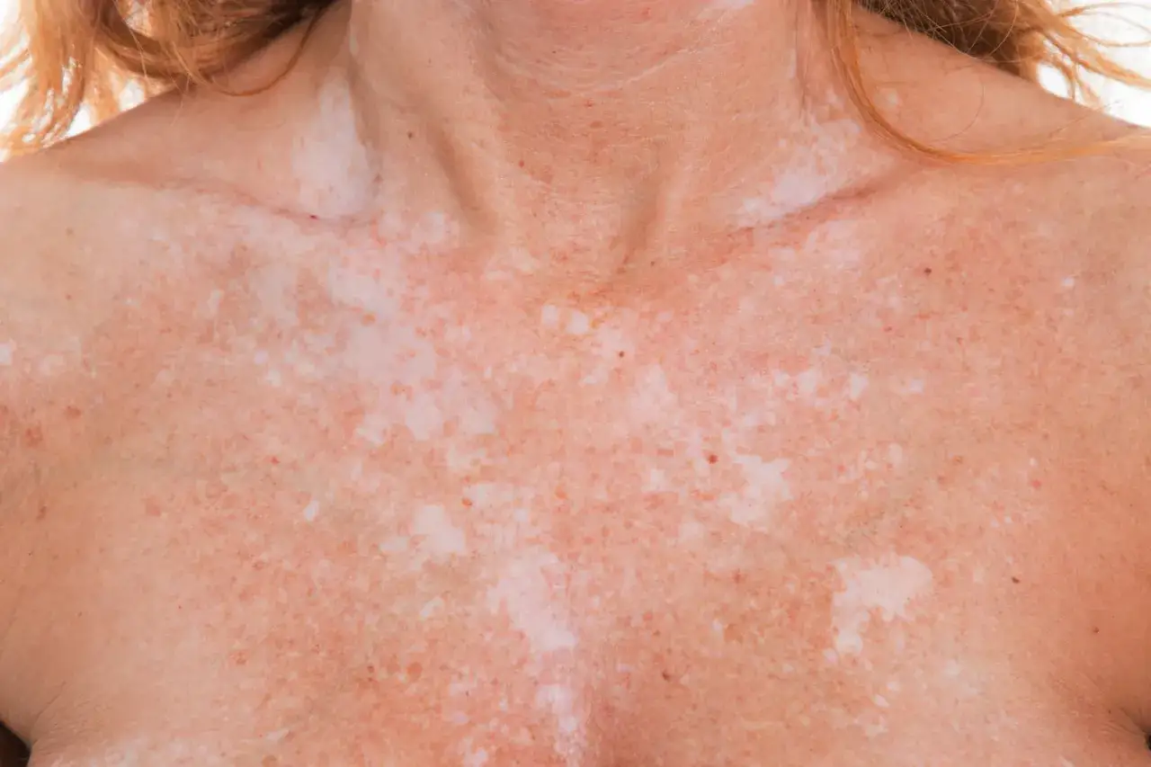 Poitrine et cou d'une femme présentant un vitiligo léger, avec des taches claires sur la peau.