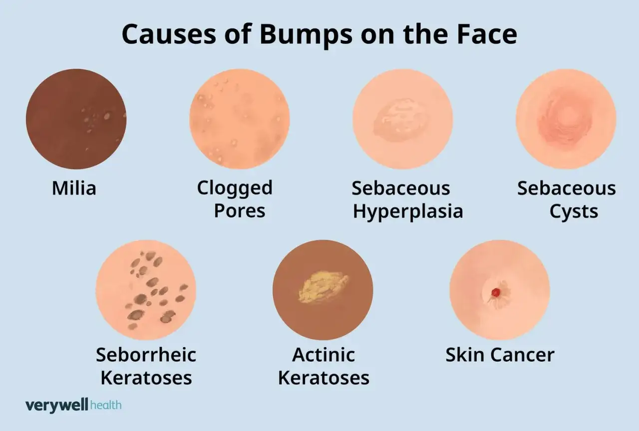 Illustrations montrant diverses causes de minuscules boutons sur le visage : milia, pores obstrués, hyperplasie sébacée, kystes sébacés, kératoses séborrhéiques, kératoses actiniques et cancer de la peau.