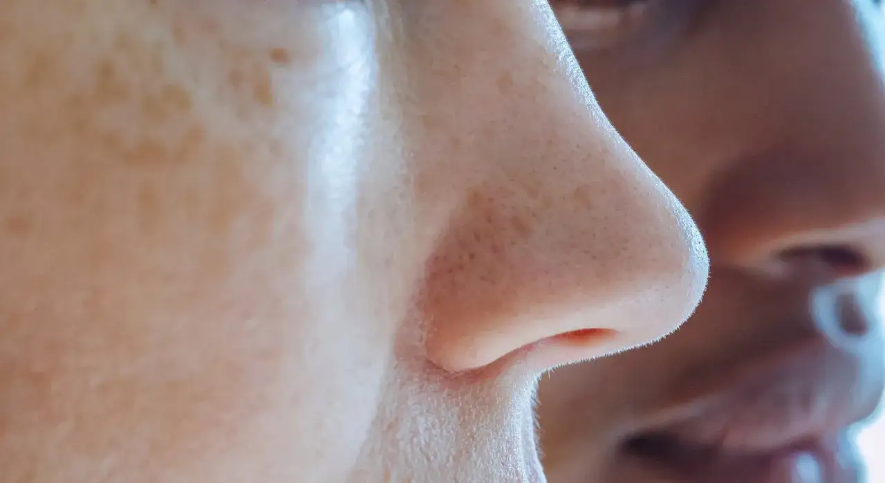 Gros plan sur un nez montrant des pores dilatés et des filaments sébacés. Une recherche de remède maison pour améliorer l'apparence de la peau.