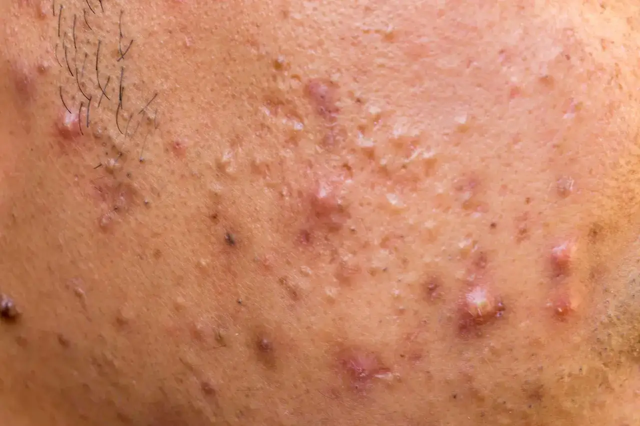 Gros plan sur une peau présentant de nombreux boutons, dont un bouton inflammatoire douloureux, avec quelques poils foncés.