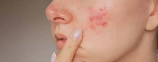 Gros plan sur une joue avec un bouton d'eczéma rouge et irrité, une personne touche délicatement la zone affectée.