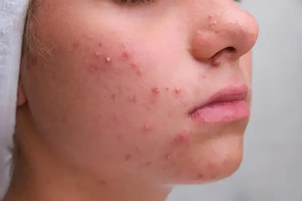 Gros plan sur un visage avec de nombreux boutons blancs et rouges, signe d'une peau à problèmes.