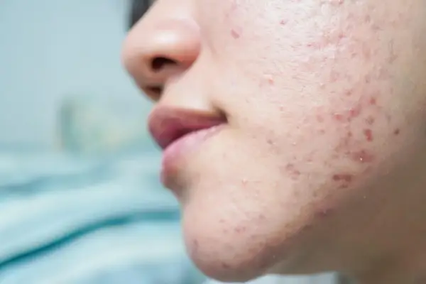Gros plan sur une peau acnéique, montrant des rougeurs et des imperfections. Ce type d'acné peut être lié à l'effet de la progestérone sur la peau.