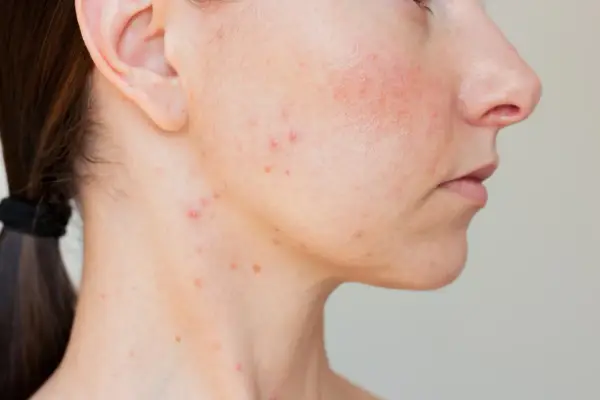 Peau du bas du visage avec des rougeurs et un bouton.