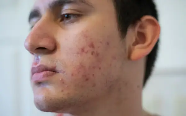 Visage d'un jeune homme avec des rougeurs et des boutons, signes d'acné nodulaire.