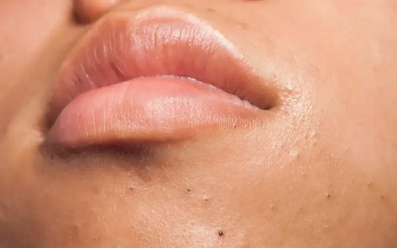 Gros plan sur des lèvres roses et une peau présentant plusieurs points noirs, ces petites imperfections qui peuvent apparaître sur le visage.
